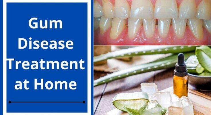 How to Cure Gum Disease Without a Dentist